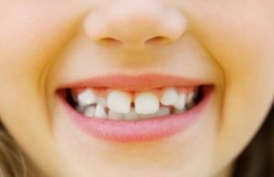 Dientes apiñados ortodoncia arguelles
