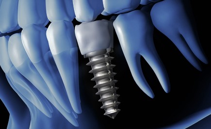 Implante dental Arguelles
