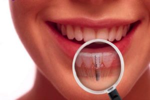 implantes dentales 5 mentiras