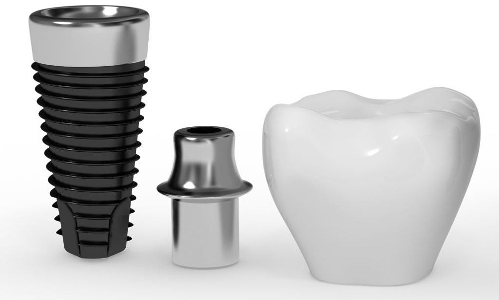 Implantes dentales Argüelles