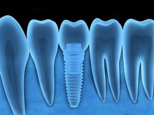 implantes dentales periimplantitis