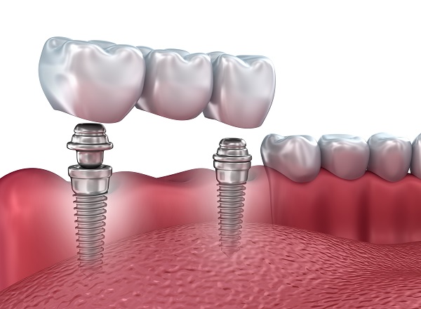Curiosidades del tratamiento con implantes dentales