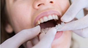 invisalign en las horas de sueño