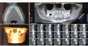 TAC 3D Implantes dentales