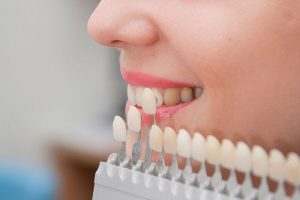 Carillas dentales clínica dental