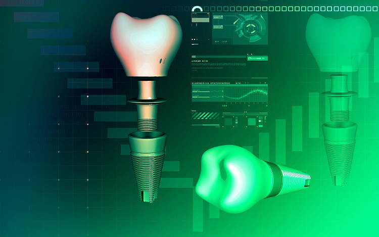 Cirugía implantes dentales guiada