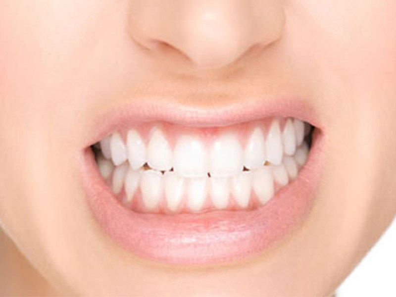 Las claves del bruxismo: síntomas y causas por las que rechinas los dientes  por la noche