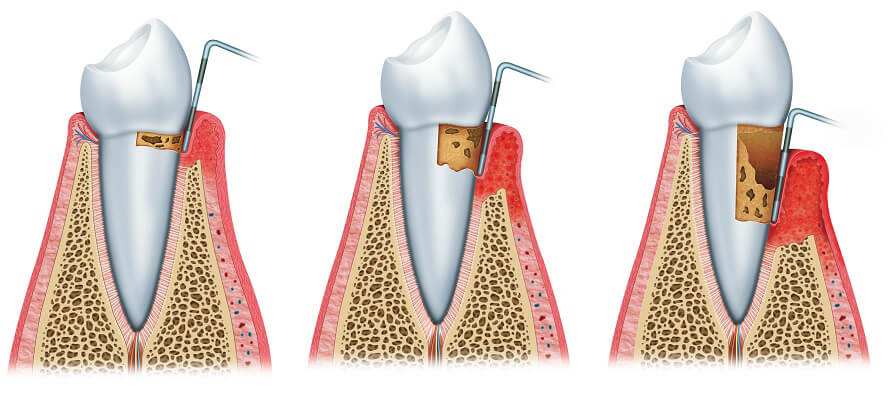 Curetajes dentistas en Madrid