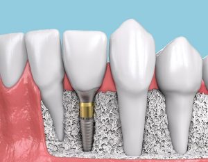 implante dental empaque