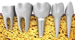 Implantes dentales sin hueso