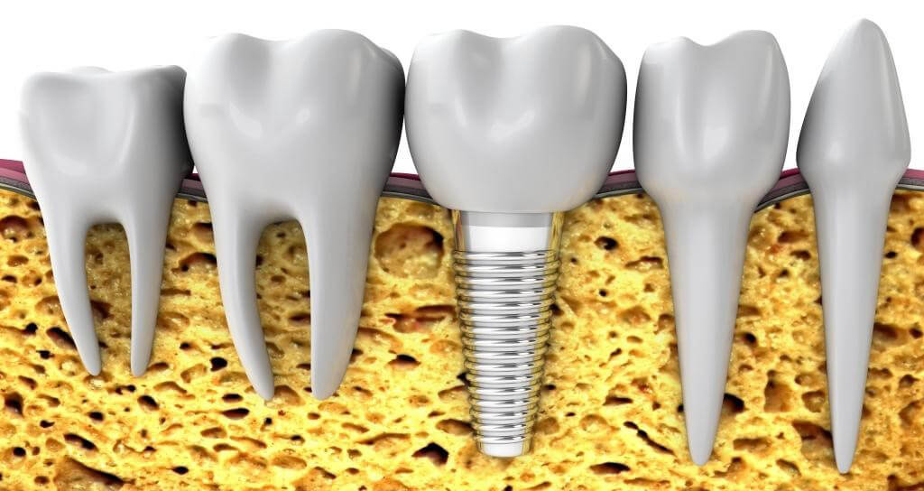 Implantes dentales poco hueso