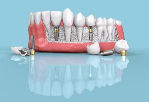 implantes dentales riesgos