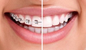 Invisalign dentistas Madrid
