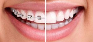 Ortodoncia en Argüelles