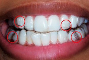 ortodoncia invisalign ataches