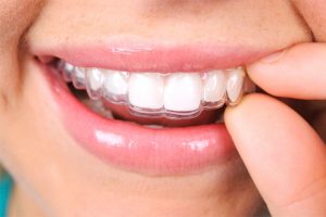 Ortodoncia invisalign en Arguelles