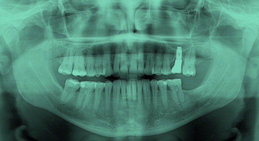 ¿Para qué sirve la radiografía panorámica dental?
