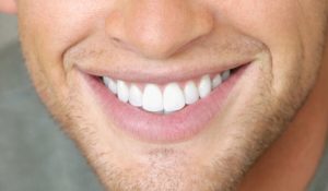 Resultados blanqueamiento dental