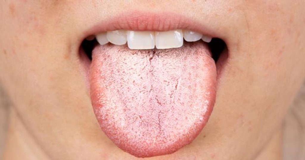Cabina Opresor Anotar Por qué tengo la lengua blanca? | Interoralia